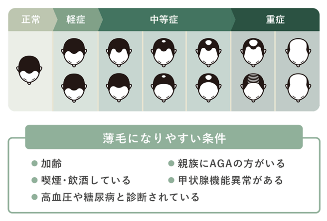 AGAの進行性に関する図