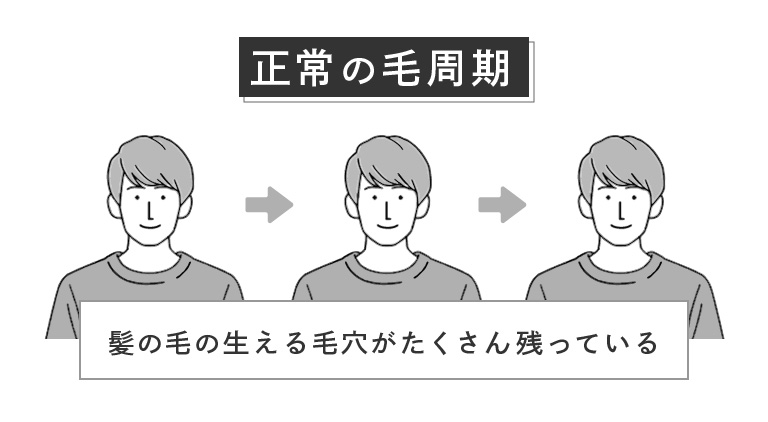 正常の毛周期は、髪の毛の生える毛穴がたくさん残っています。