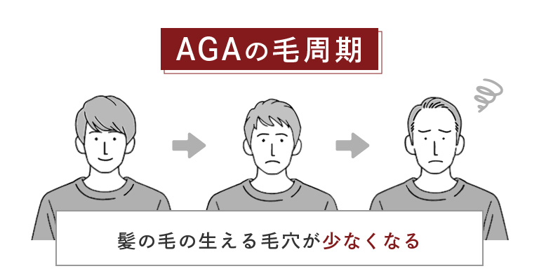 AGA髪の毛周期は、髪の毛の生える毛穴が少なくなります。