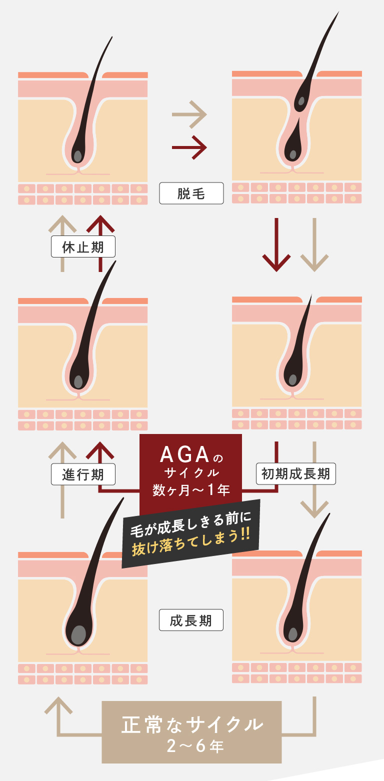 AGAのサイクルは数ヶ月〜1年。毛が成長しきる前に抜け落ちてしまいます。