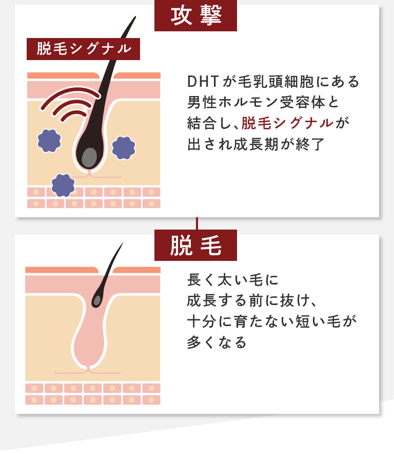 「攻撃」DHTが毛乳頭細胞にある男性ホルモン受容体と結合し、脱毛シグナルが出され成長期が終了。「脱毛」長く太い毛に成長する前に抜け、十分に育たない短い毛が多くなる。